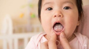 あかちゃんの鵞口瘡（口腔カンジダ）